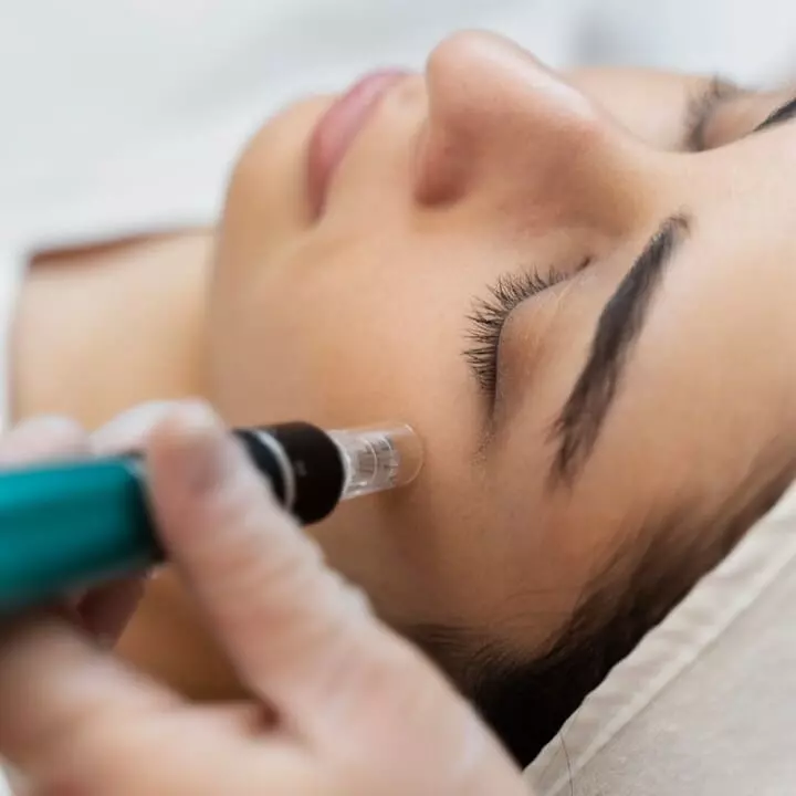 Microneedling